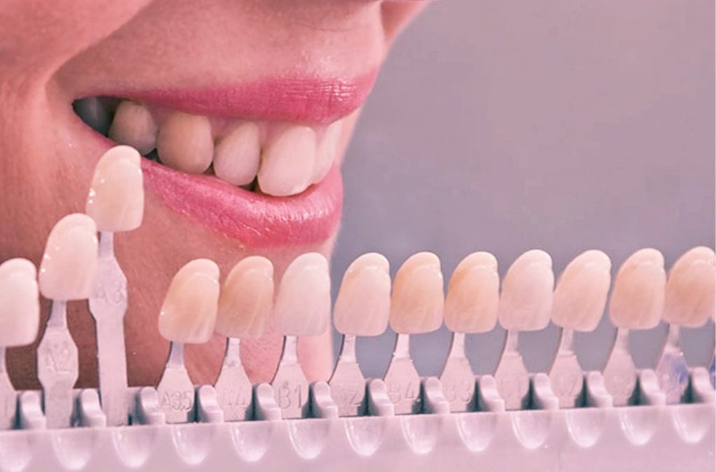 A Tonalidade dos Dentes